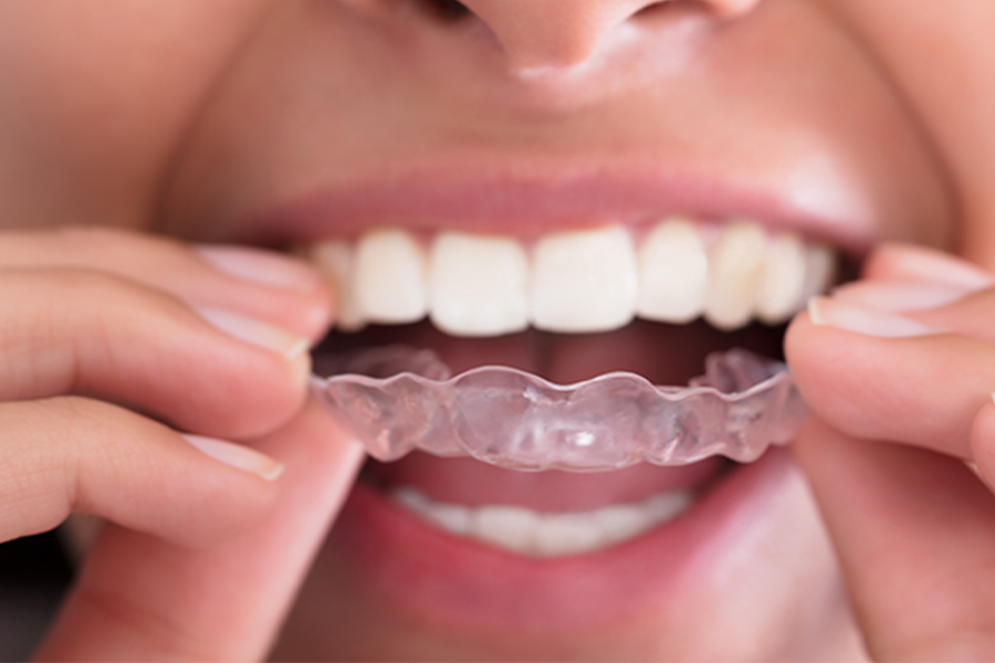 How to Clean Invisalign