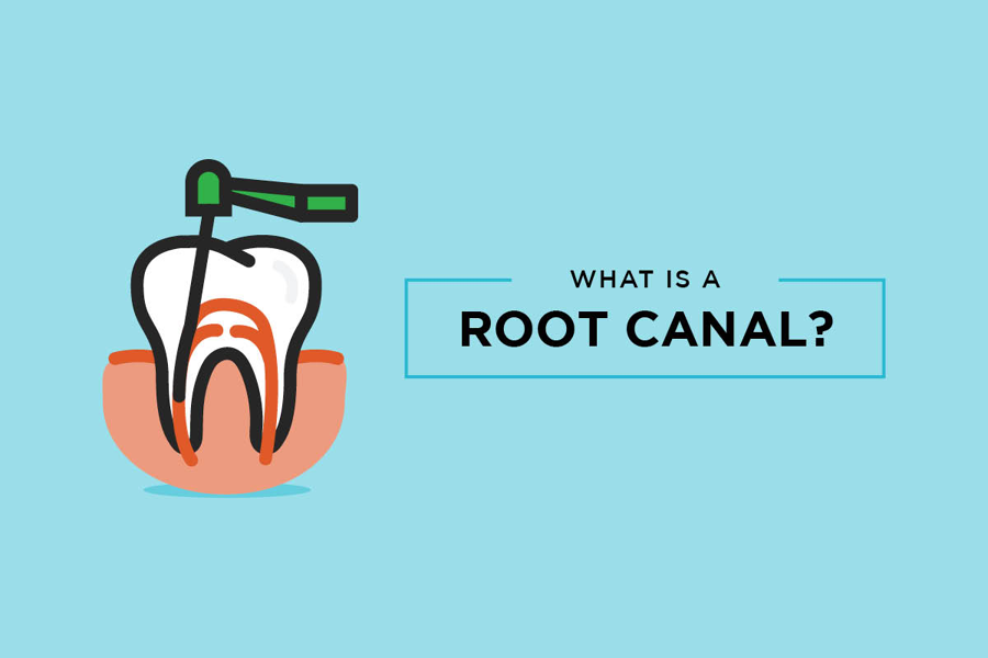 Root canals are a dental procedure that treats infection in teeth. Without root canals, serious infe