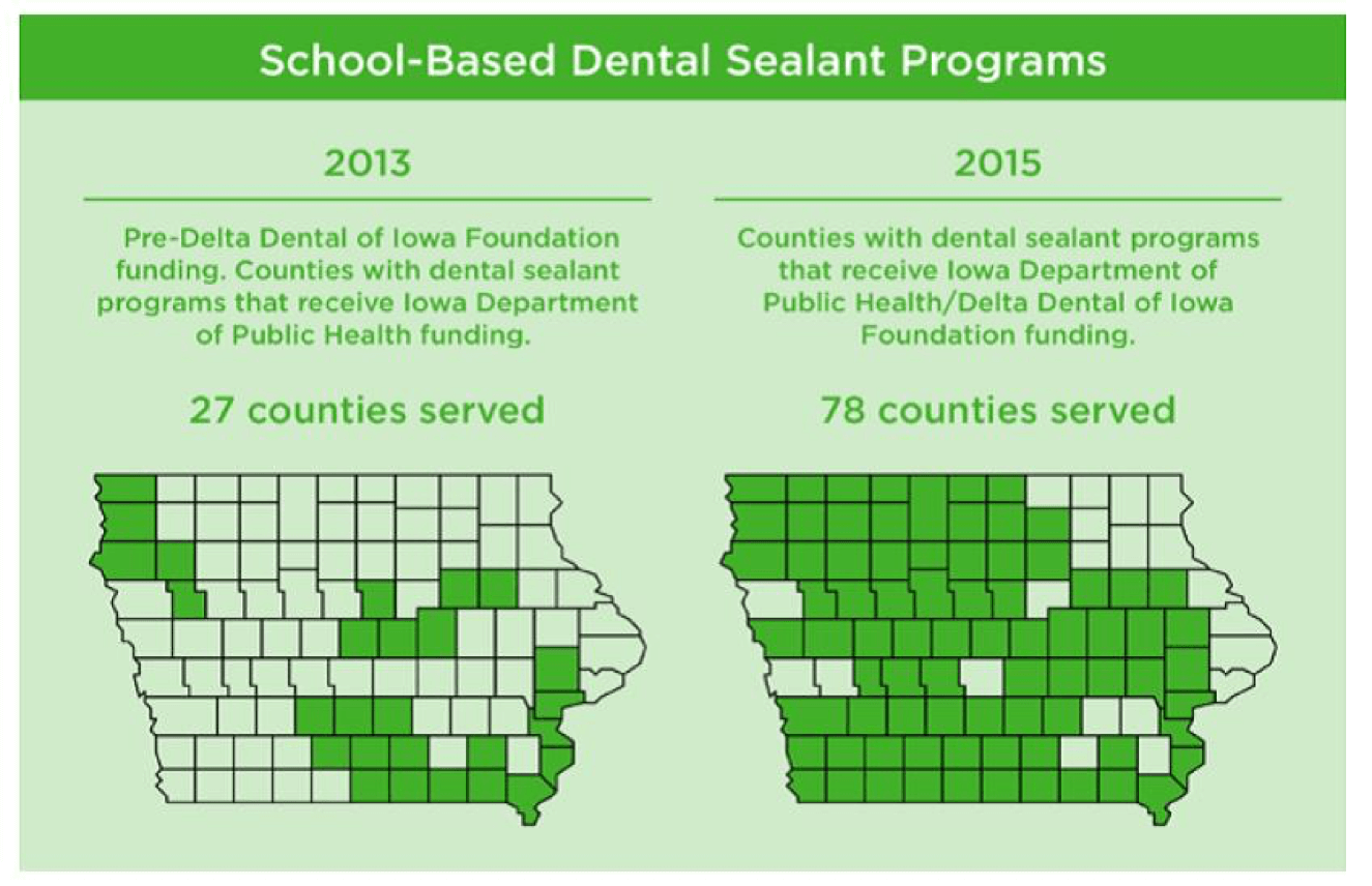 Dental Sealants