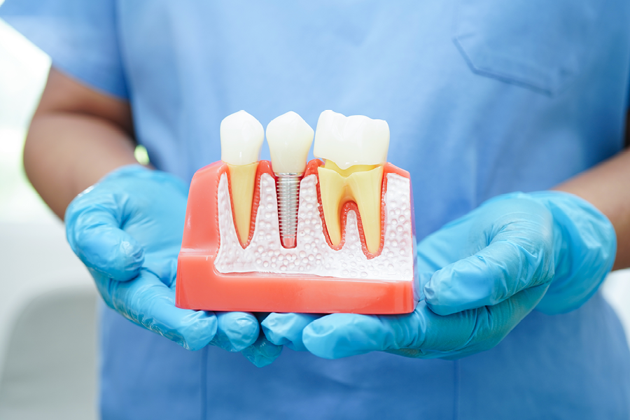 Dentist showing a model of a dental implant.