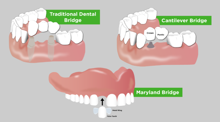 Three diagrams show how traditional, Cantilever, and Maryland dental bridges operate in the mouth.