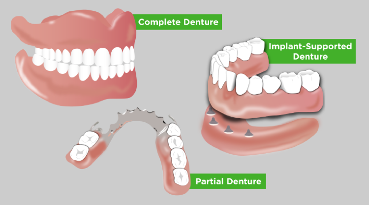 Three diagrams show how complete, partial, and implant-supported dentures operate in the mouth.