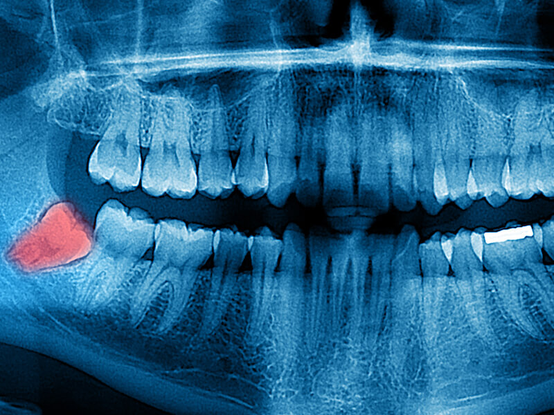 What do you know really know about your wisdom teeth?