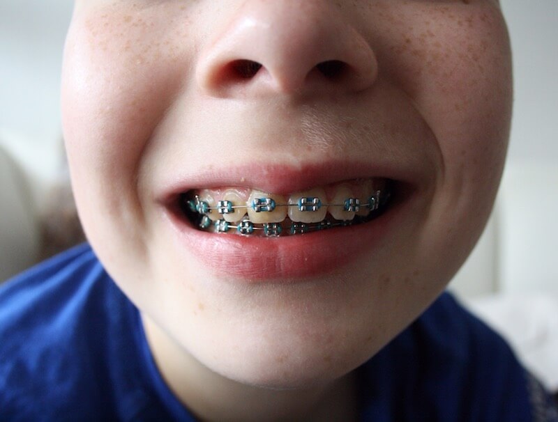How to Financially “Brace” for Orthodontia