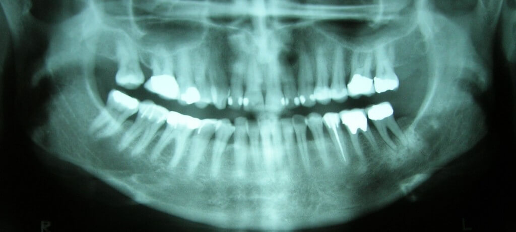 delta dental of iowa - oral cancer risks