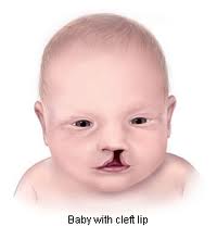 cleft