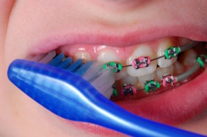 orthodontist-brushing-braces